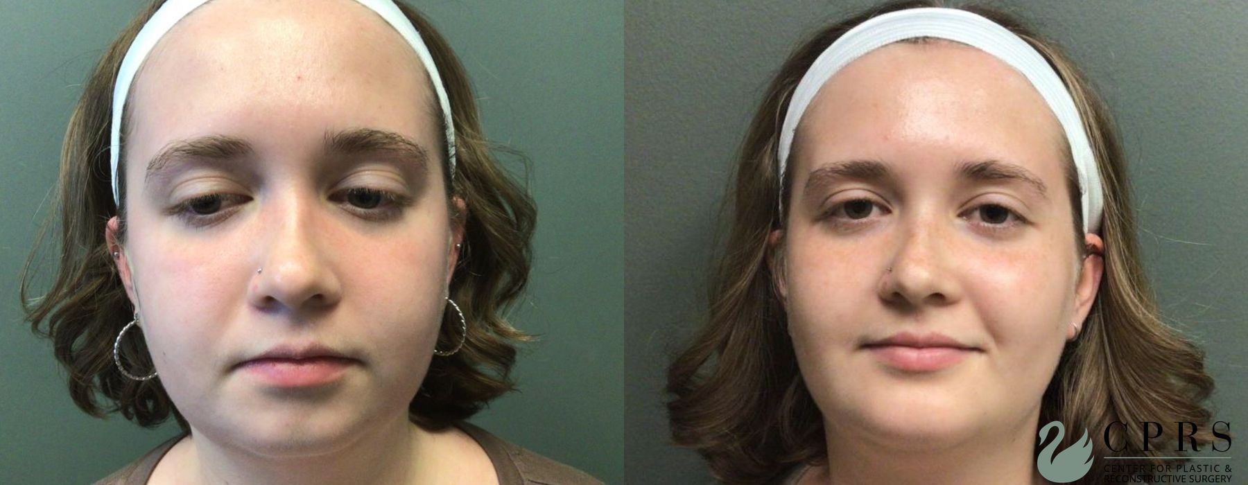Before and after Chin Augmentation case 19123