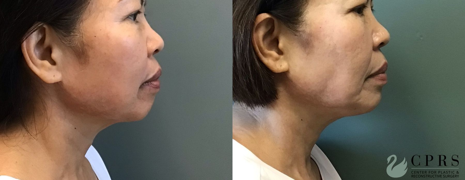 Before and after Chin Augmentation case 23844