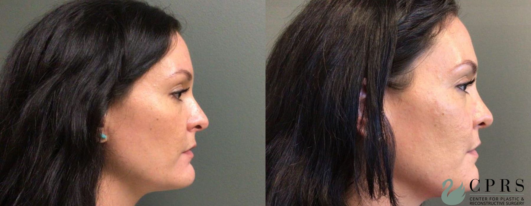Before and after Chin Reduction case 19109 - Angle 2