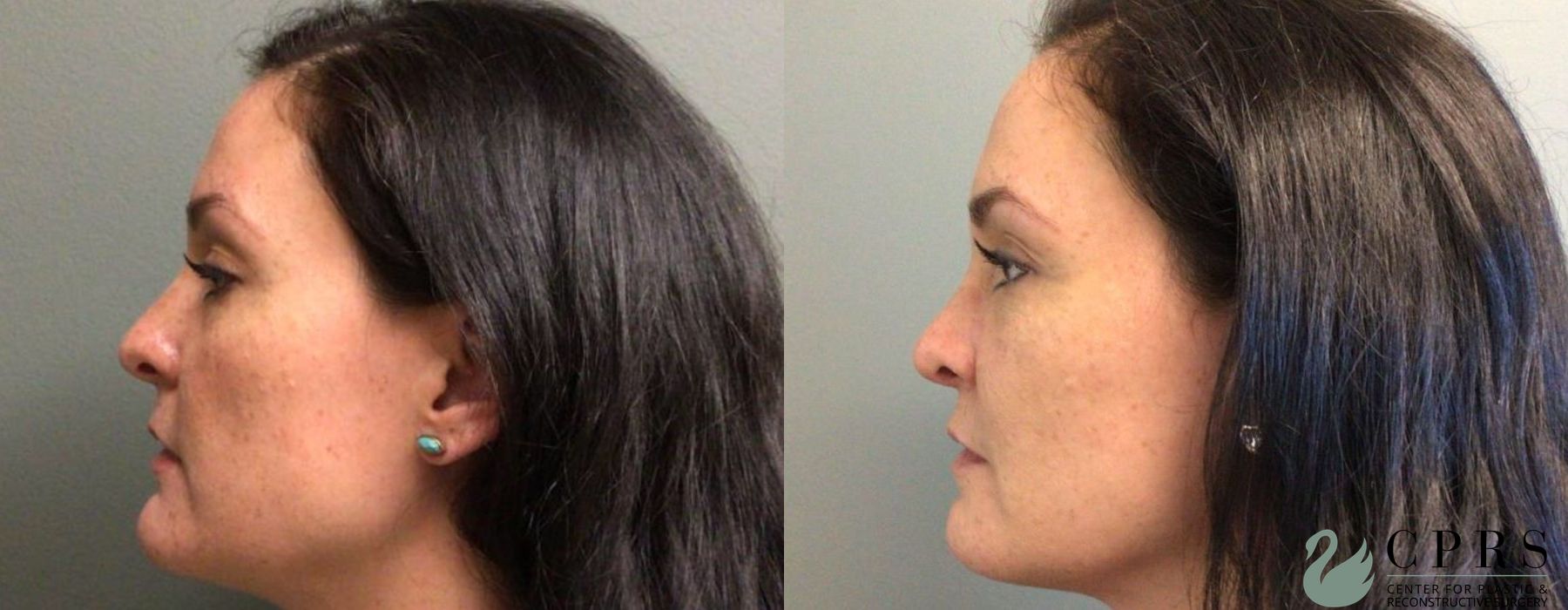 Before and after Chin Reduction case 19109
