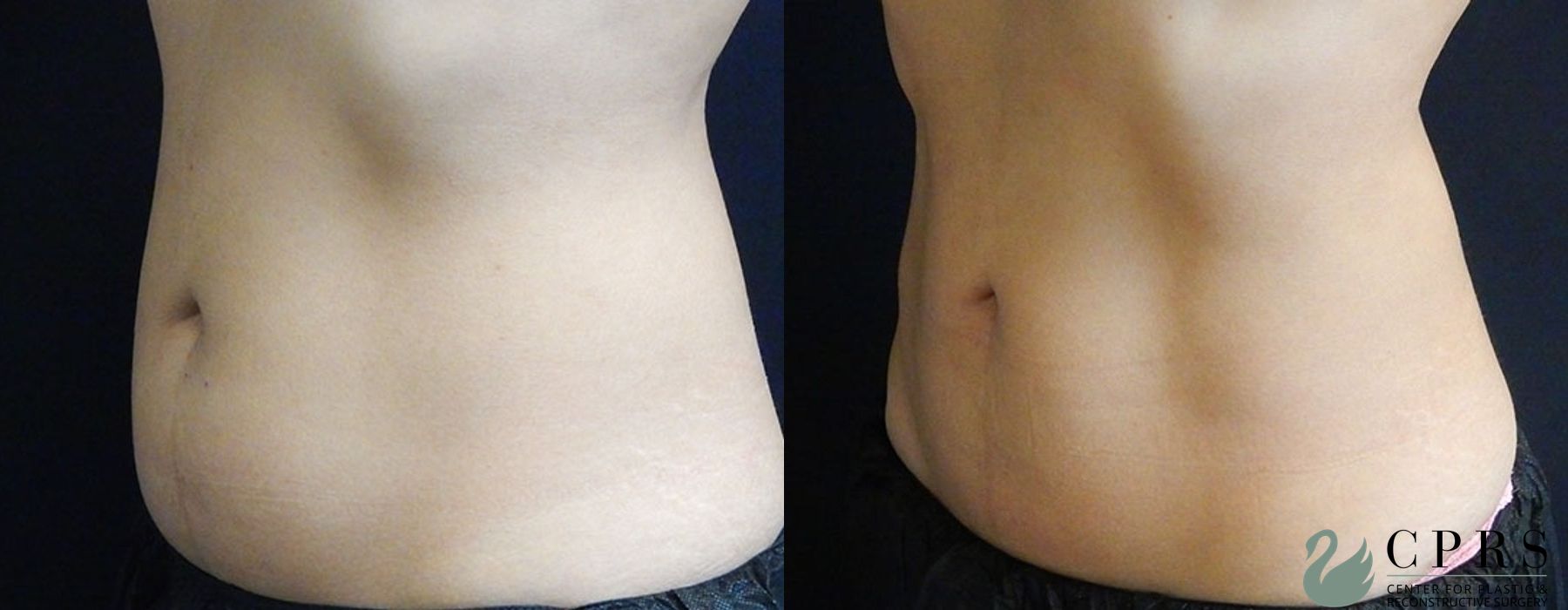 Before and after CoolSculpting® case 19059 - Angle 2