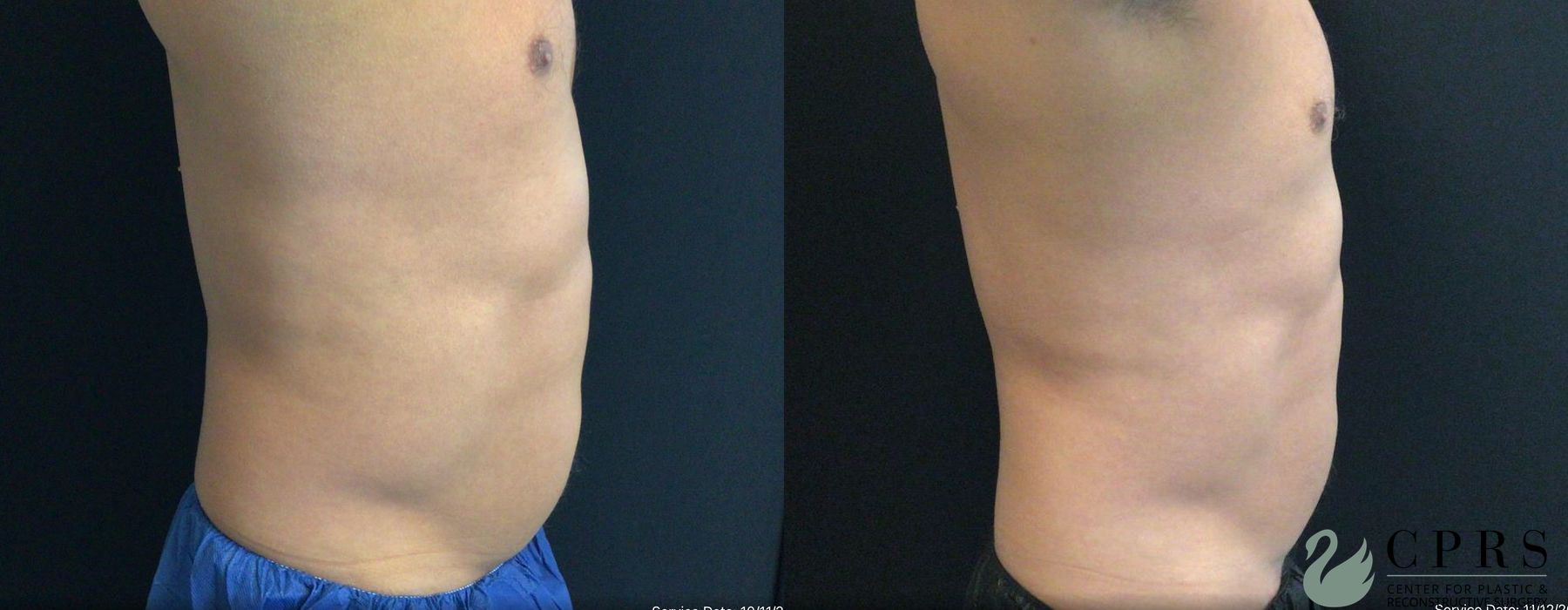 Before and after CoolSculpting® case 19029 - Angle 3