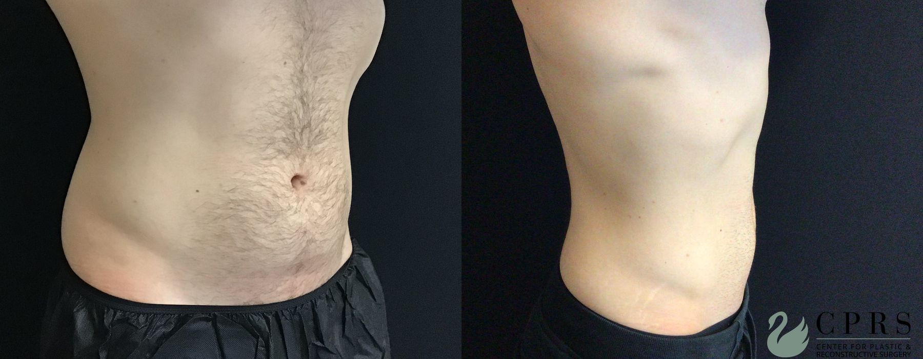 Before and after CoolSculpting® case 19074 - Angle 2