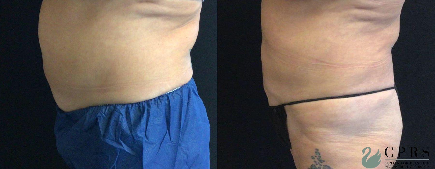 Before and after CoolSculpting® case 19083 - Angle 3