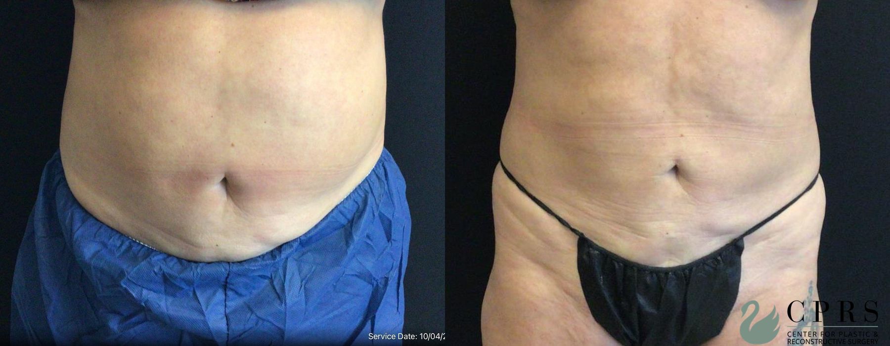 Before and after CoolSculpting® case 19083