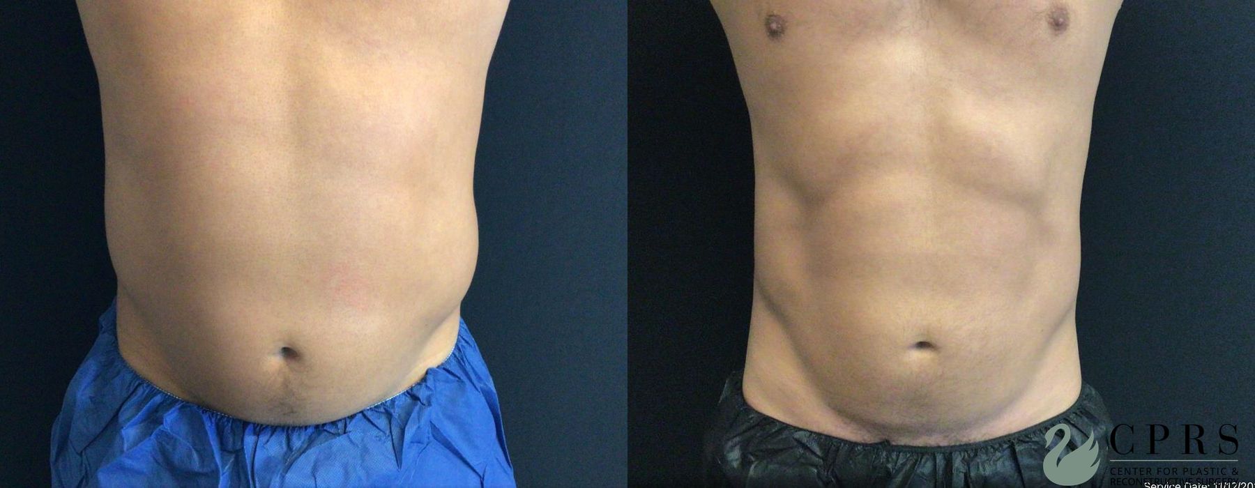 Before and after CoolSculpting® case 19029