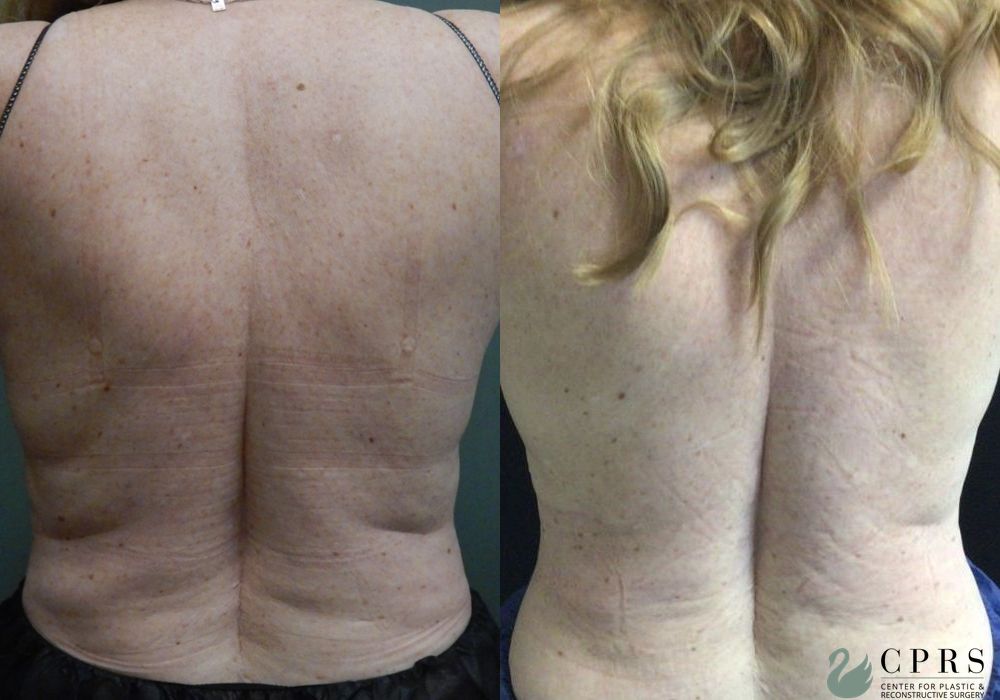 Before and after CoolSculpting® case 19087