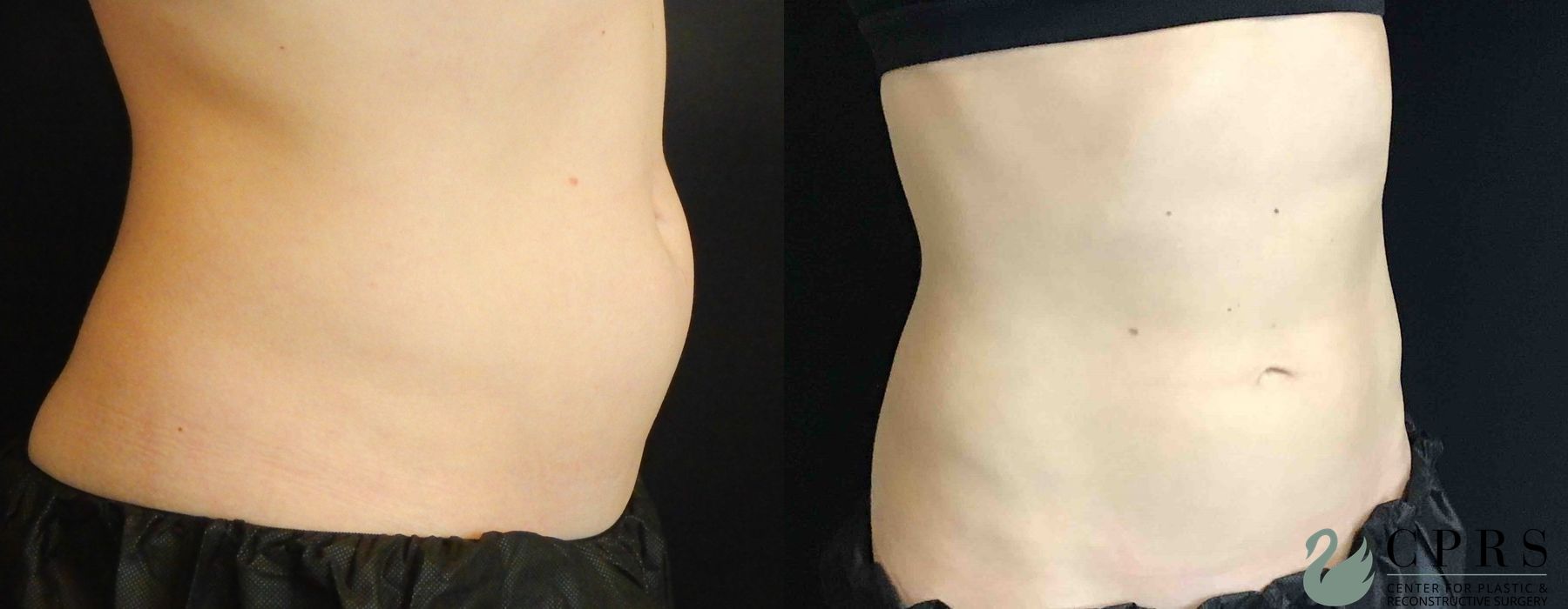 Before and after CoolSculpting® case 19086 - Angle 2