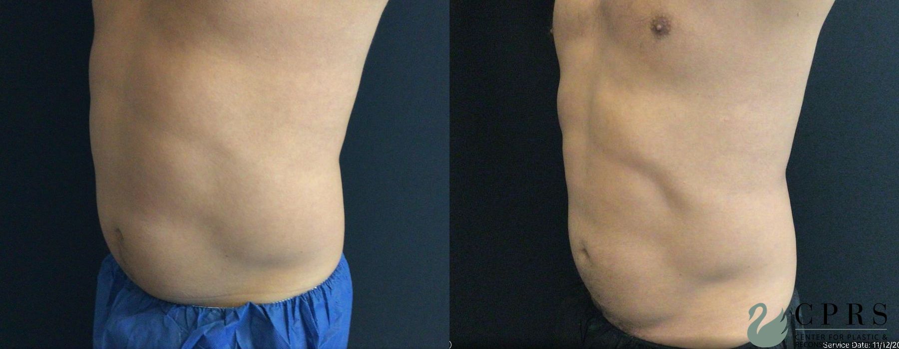 Before and after CoolSculpting® case 19029 - Angle 2