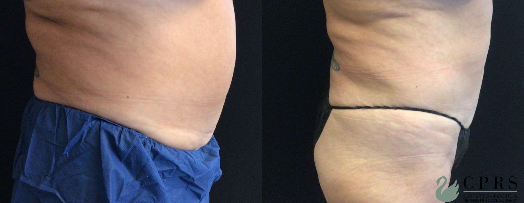 Before and after CoolSculpting® case 19083 - Angle 2