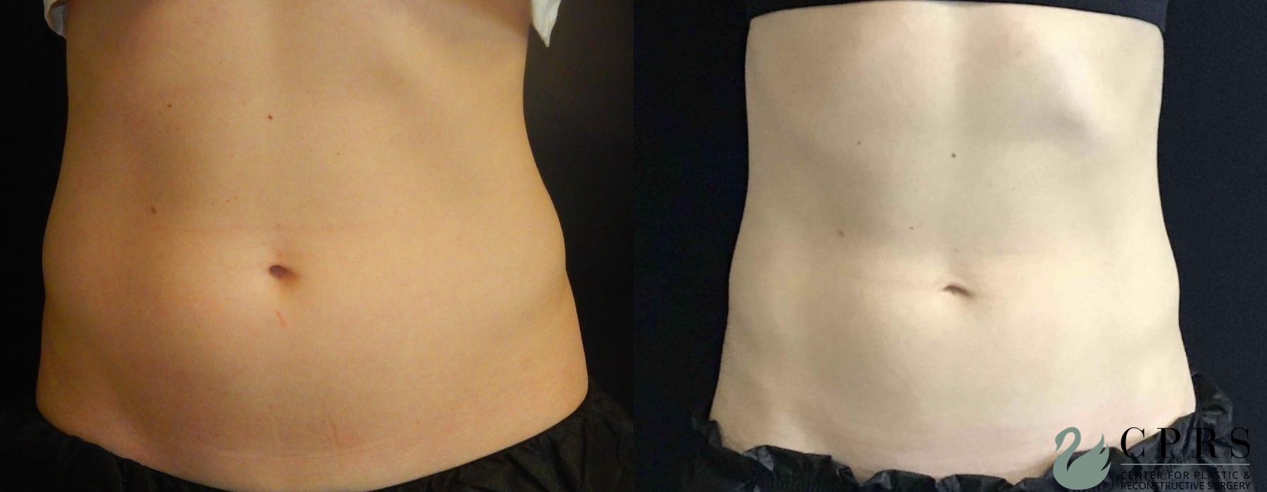 Before and after CoolSculpting® case 19086