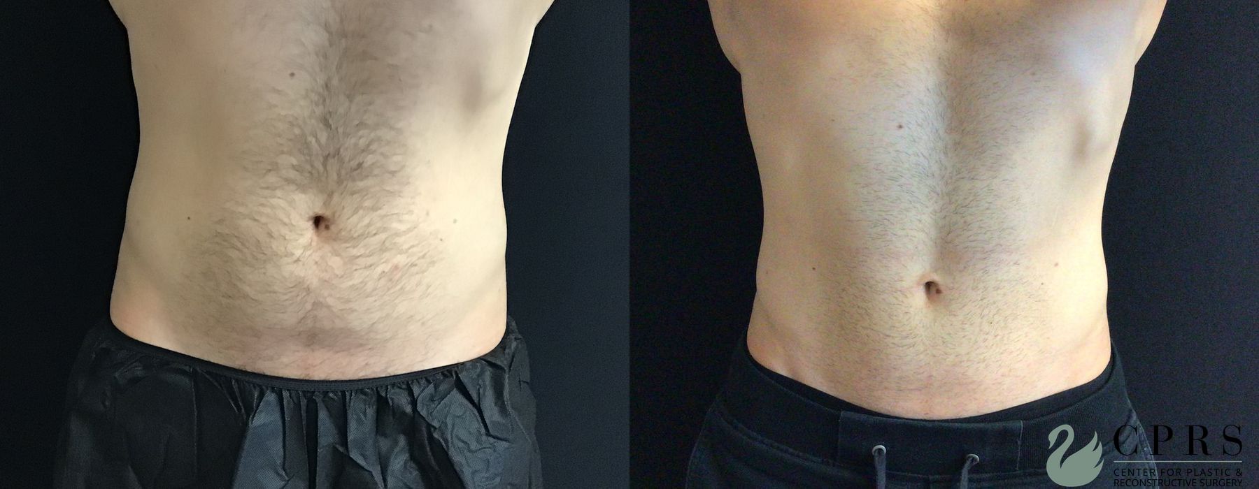 Before and after CoolSculpting® case 19074