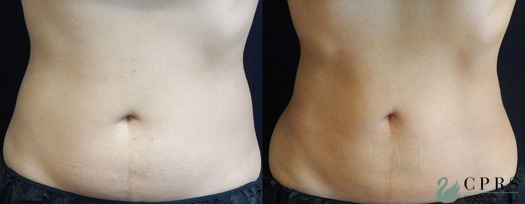 Before and after CoolSculpting® case 19059