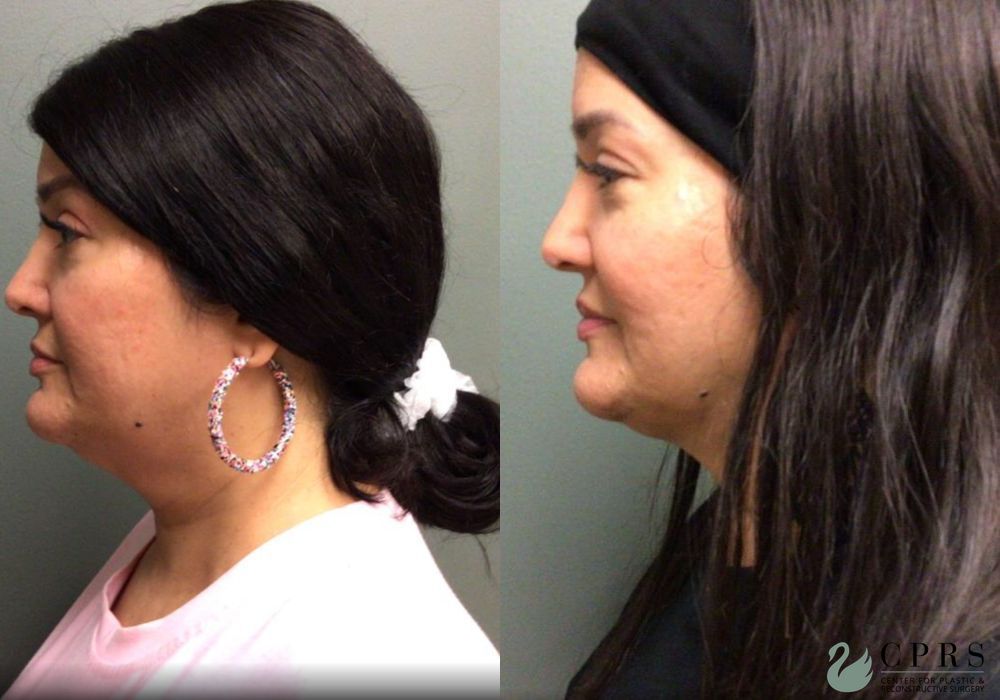 Before and after FaceTite case 19017 - Angle 2