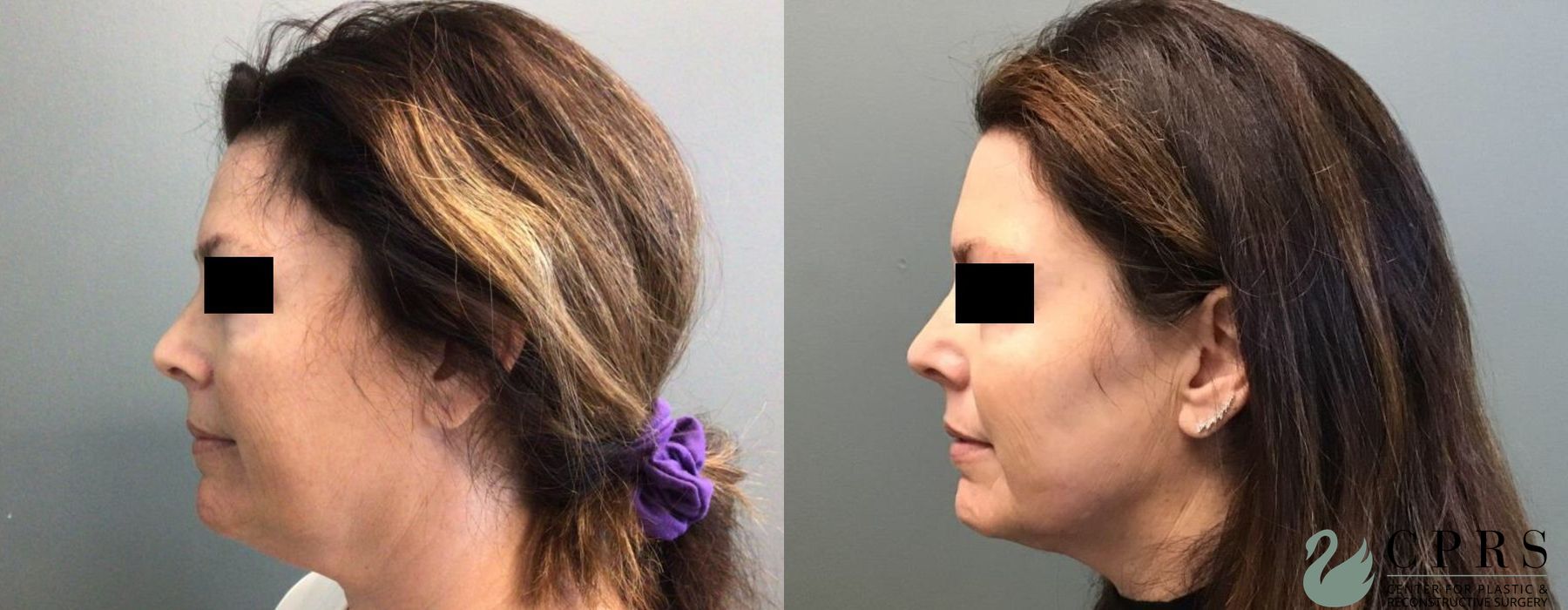 Before photo - Angle 3