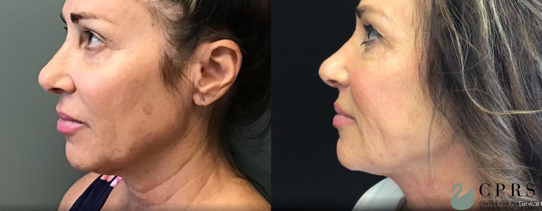 Before and after FaceTite case 19079