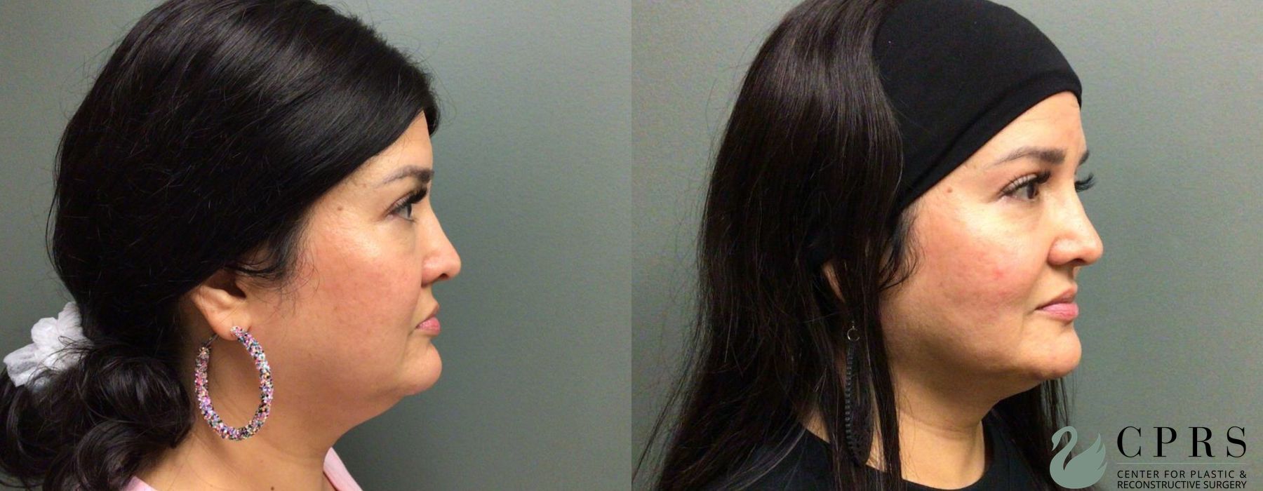 Before photo - Angle 3