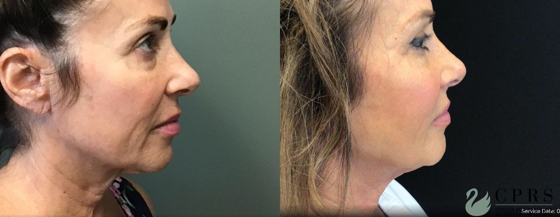 Before and after FaceTite case 19079 - Angle 2