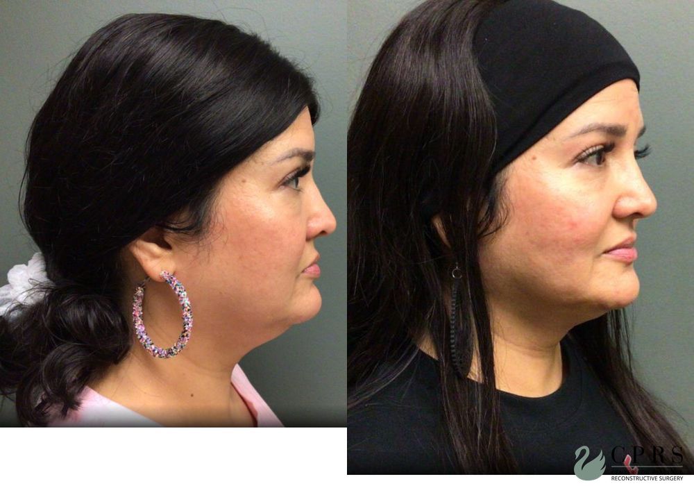 Before and after FaceTite case 19017
