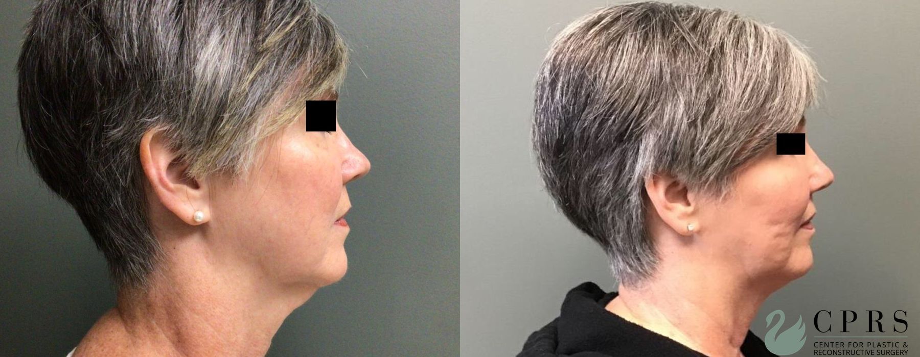 Before photo - Angle 2