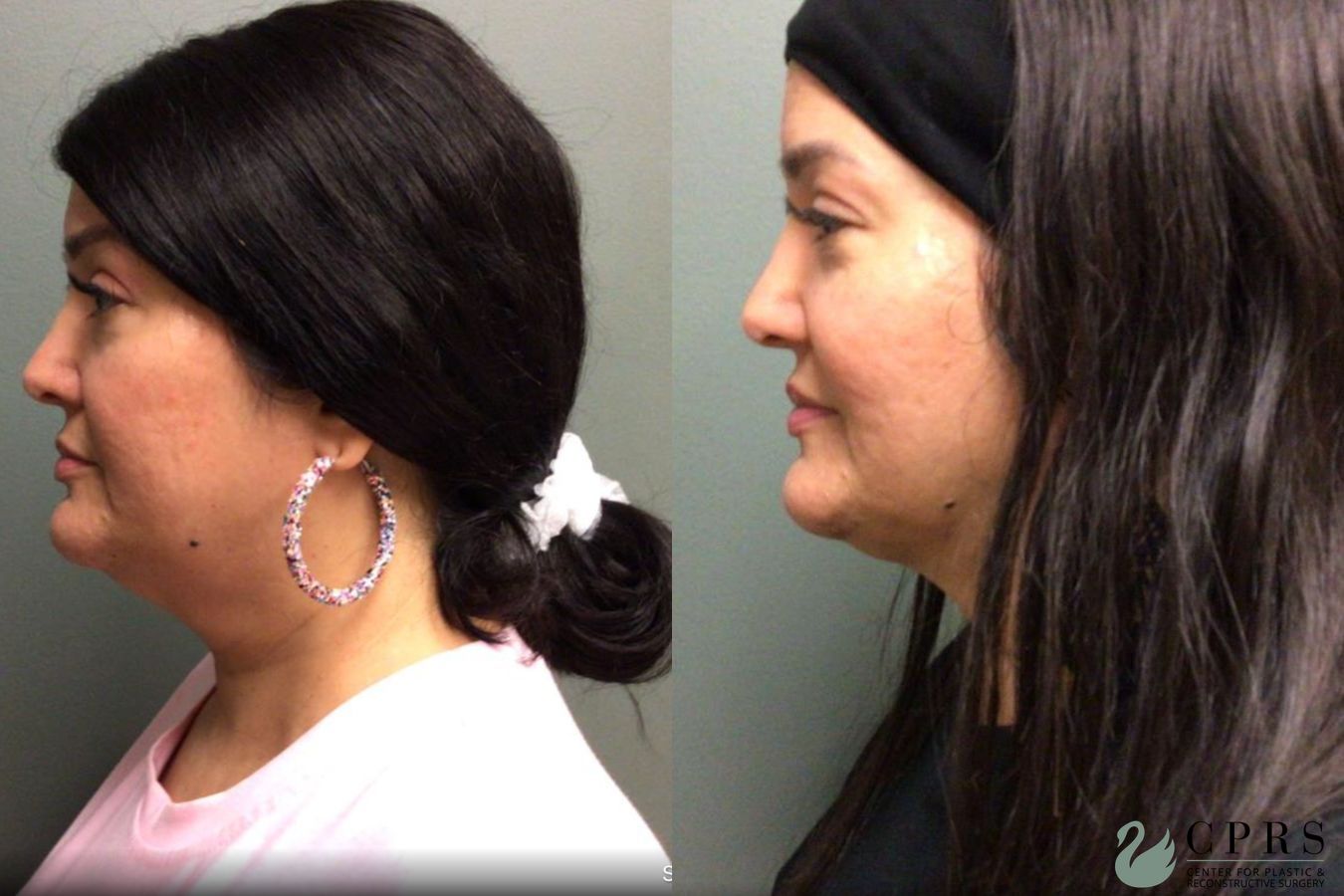 Before and after FaceTite case 19017 - Angle 2