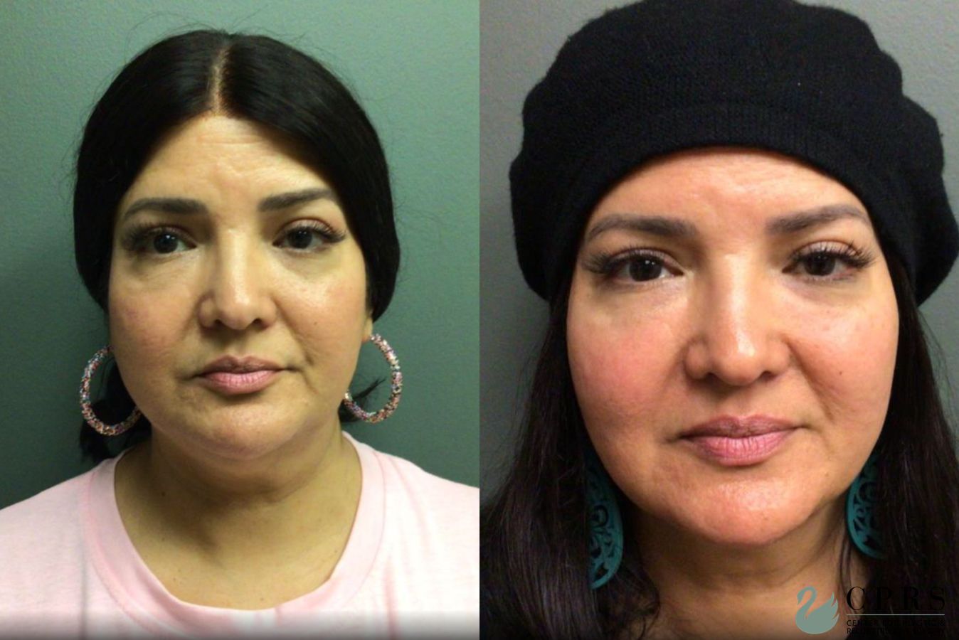 Before and after FaceTite case 19017 - Angle 3