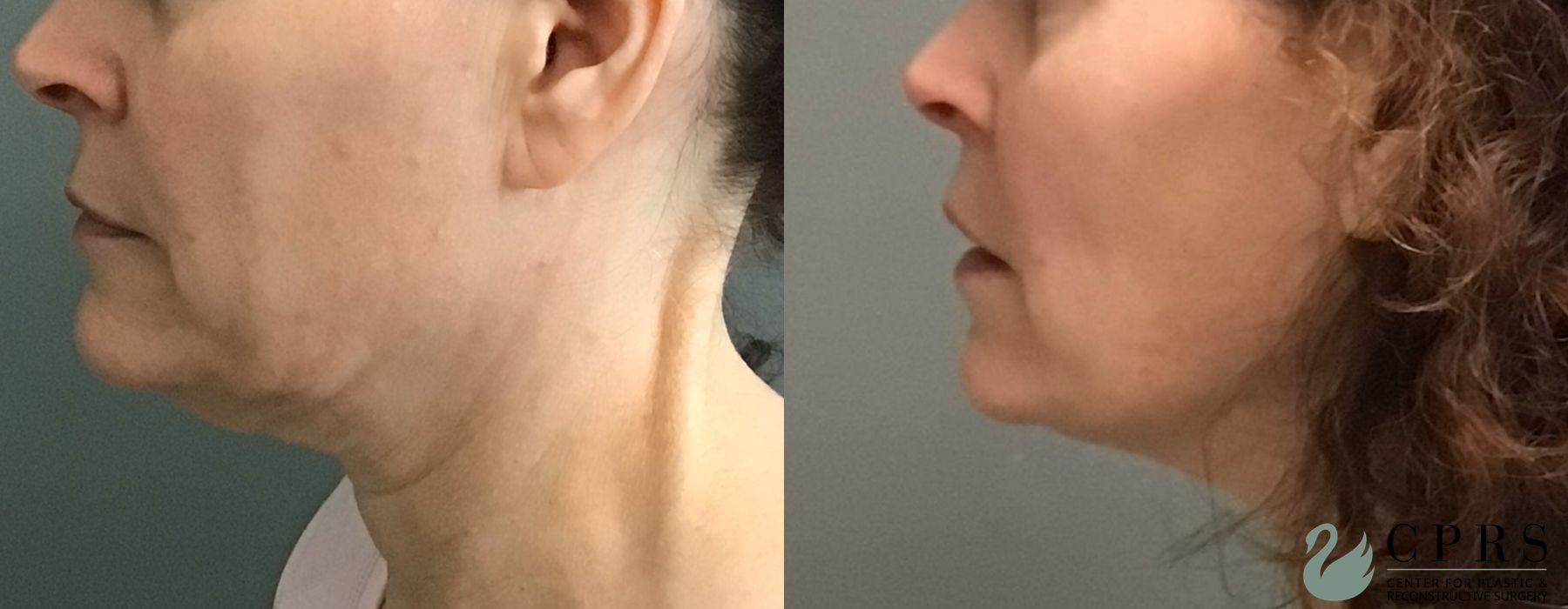 Before and after FaceTite case 23875