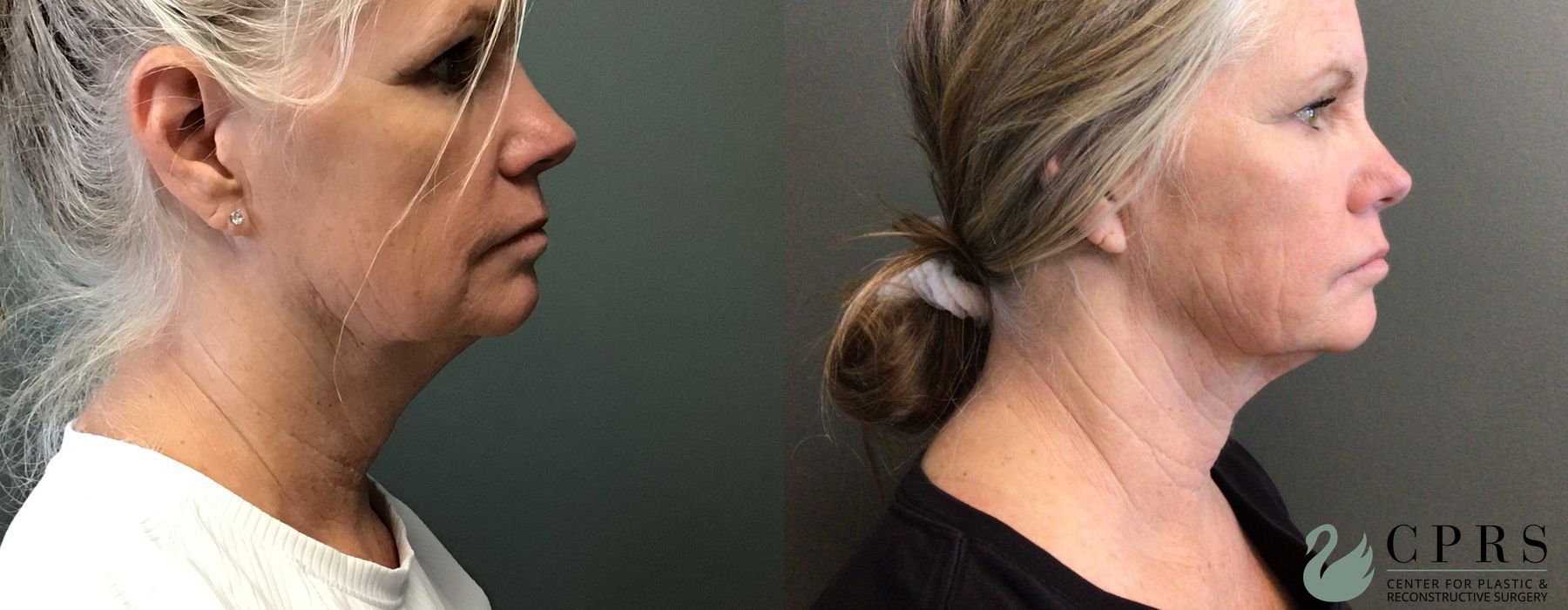 Before and after FaceTite case 38052