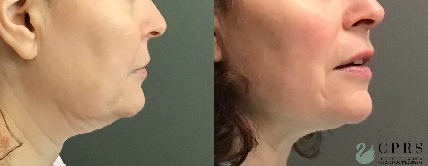 Before and after FaceTite case 23875 - Angle 2