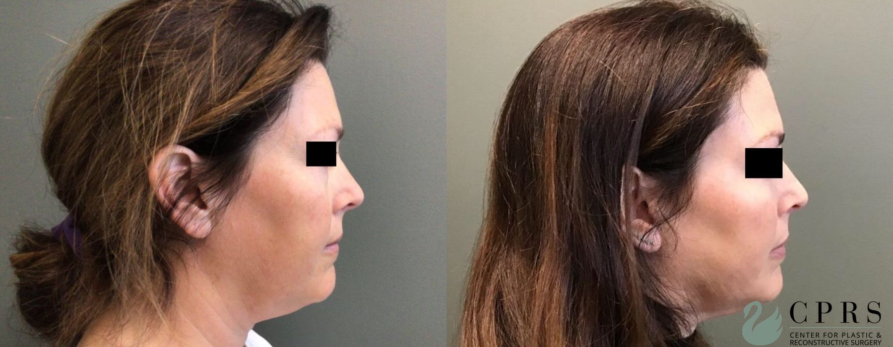 Before photo - Angle 2