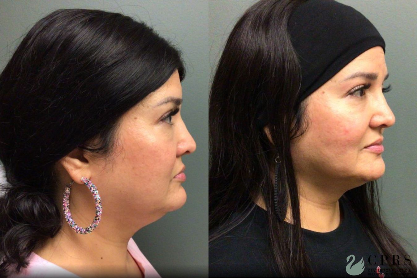 Before and after FaceTite case 19017