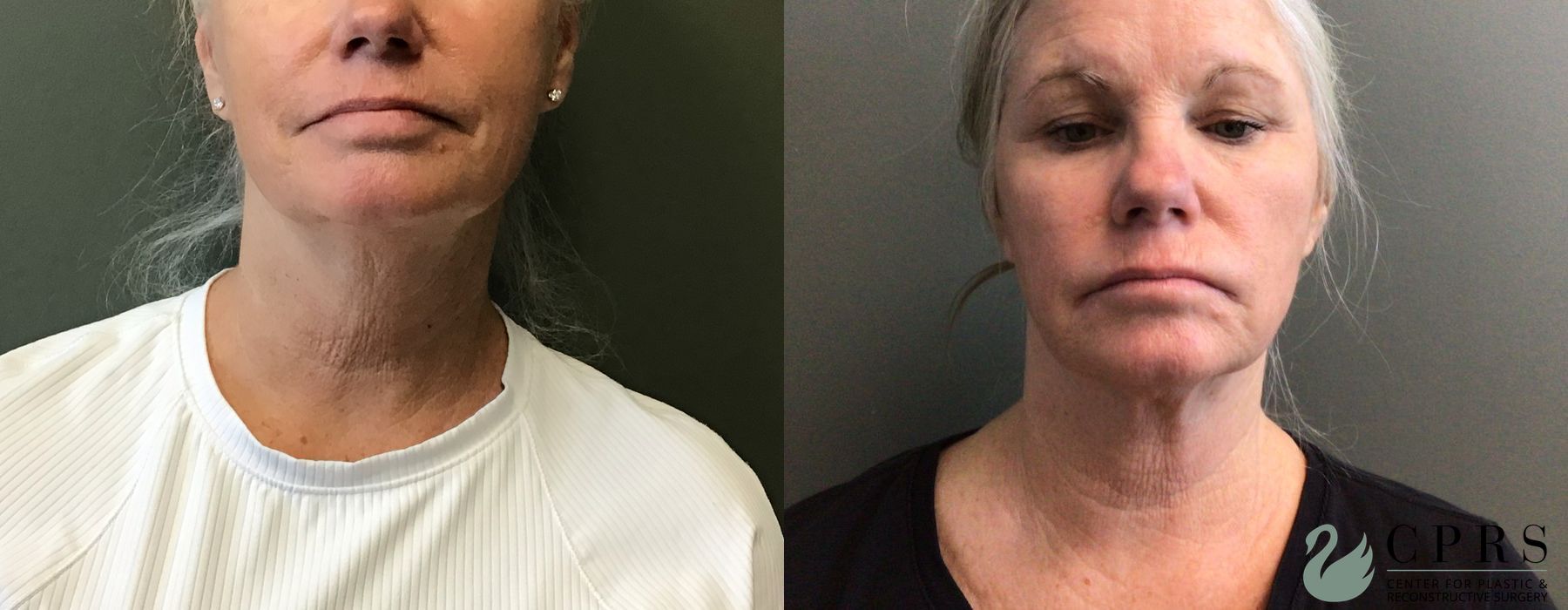 Before and after FaceTite case 38052 - Angle 2