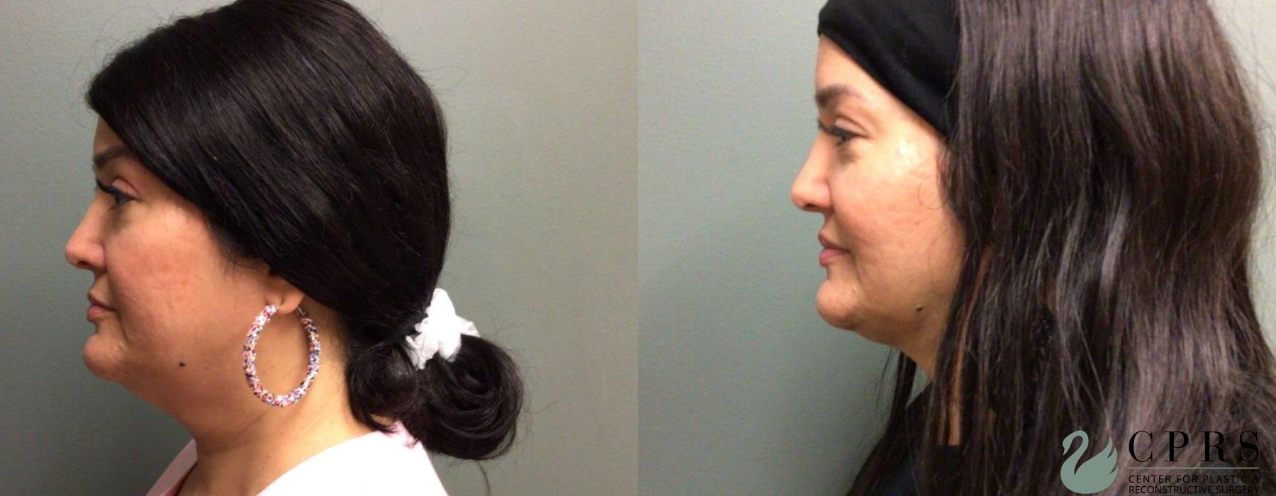 Before photo - Angle 2