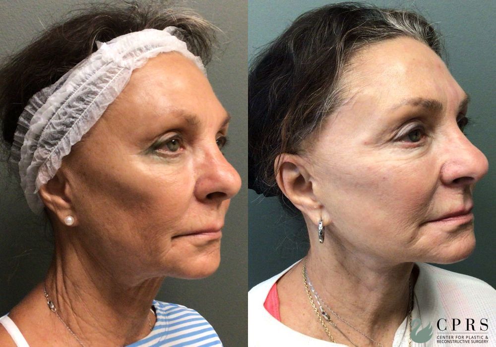 Before and after Facelift case 36796 - Angle 2