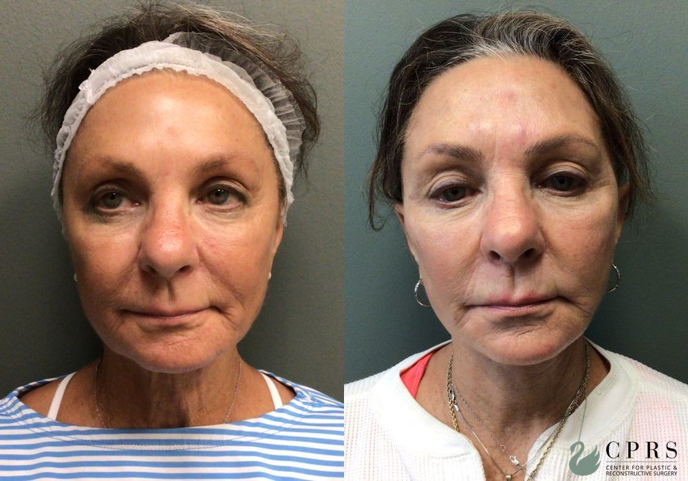 Before and after Facelift case 36796 - Angle 3