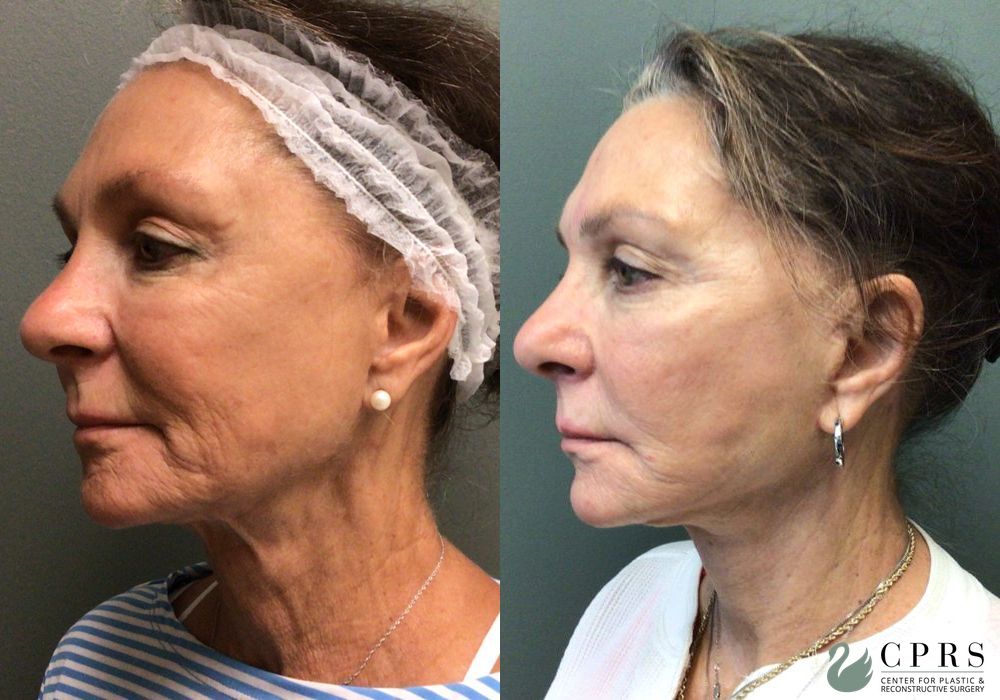 Before and after Facelift case 36796