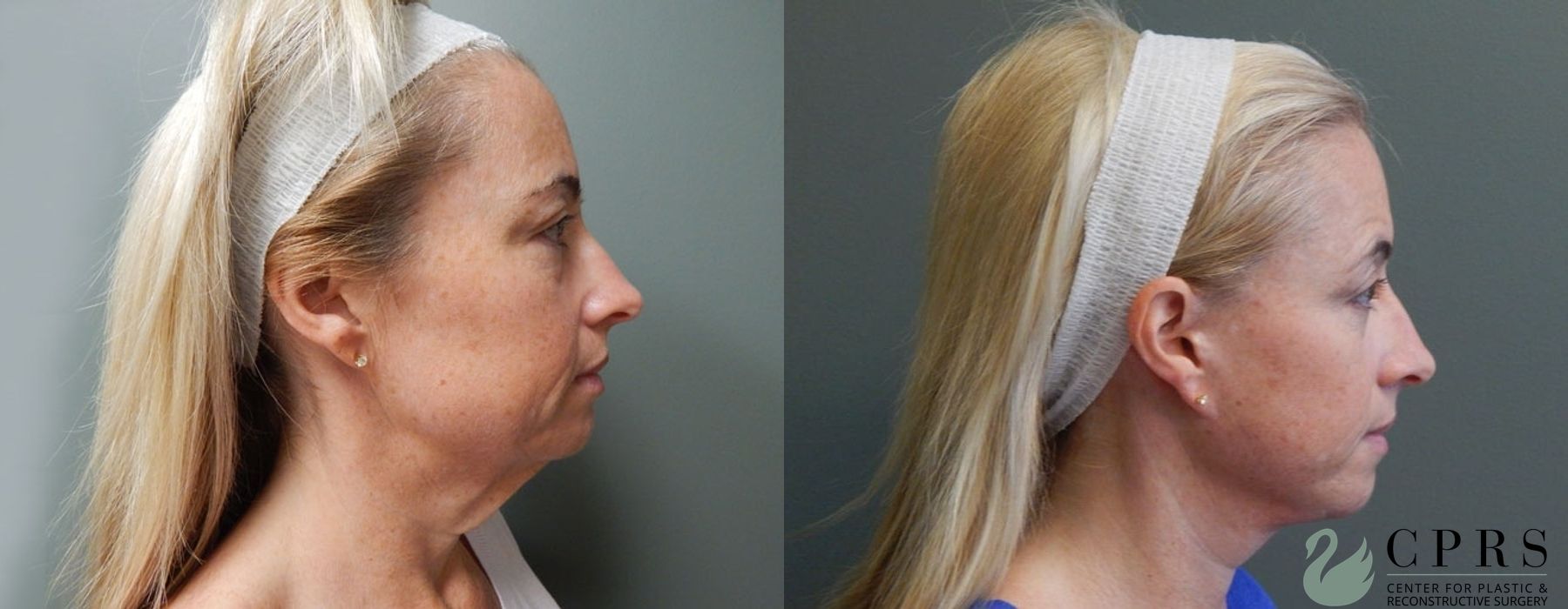 Before and after Facelift & Neck Lift case 19060 - Angle 3
