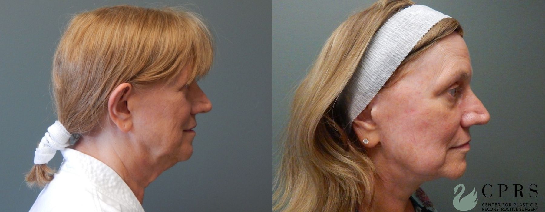 Before photo - Angle 2