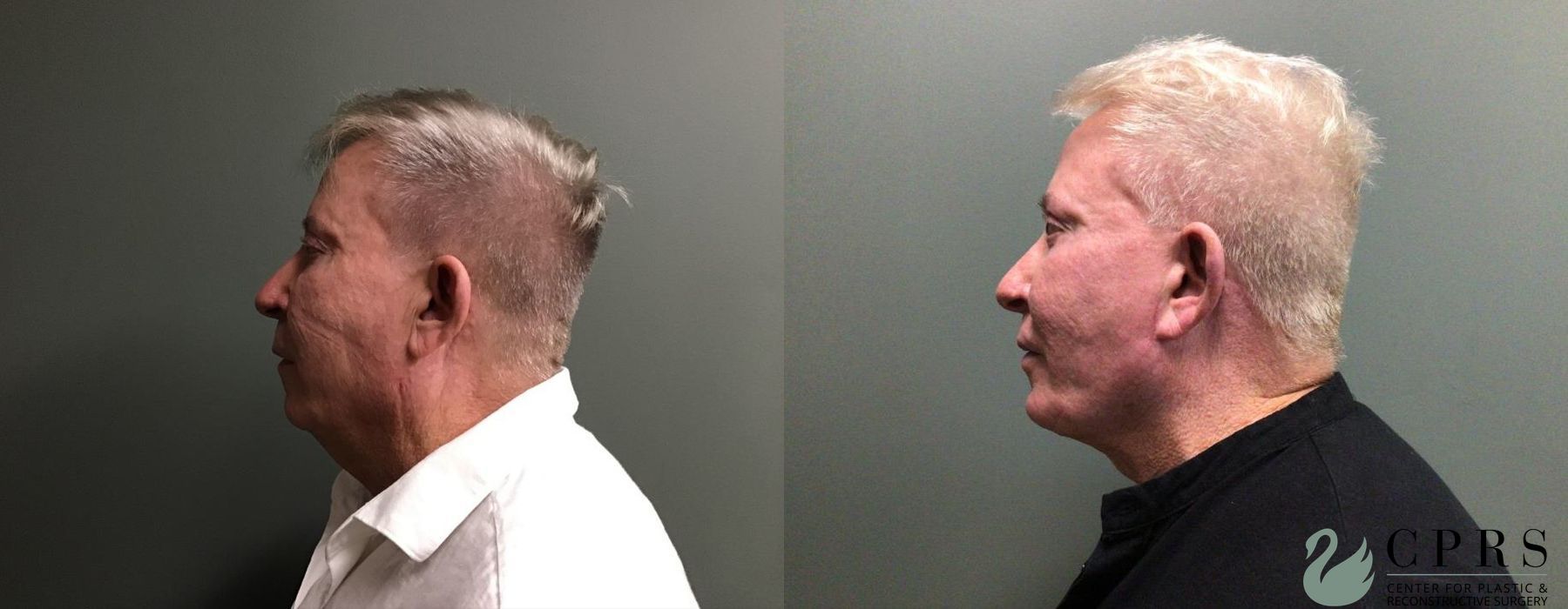Before and after Facelift & Neck Lift case 19069 - Angle 4