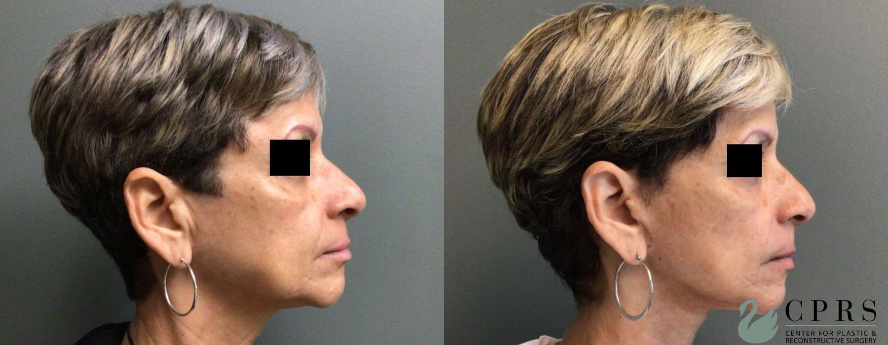 Before photo - Angle 3