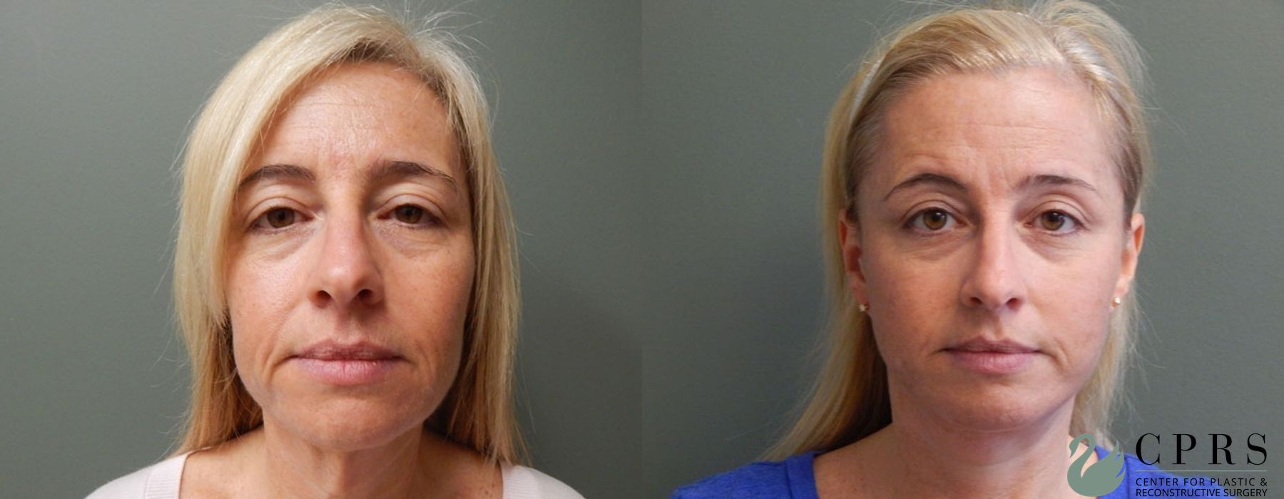 Before and after Facelift & Neck Lift case 19060
