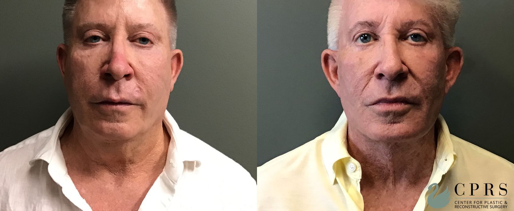 Before and after Chin Augmentation case 49393 - Angle 3