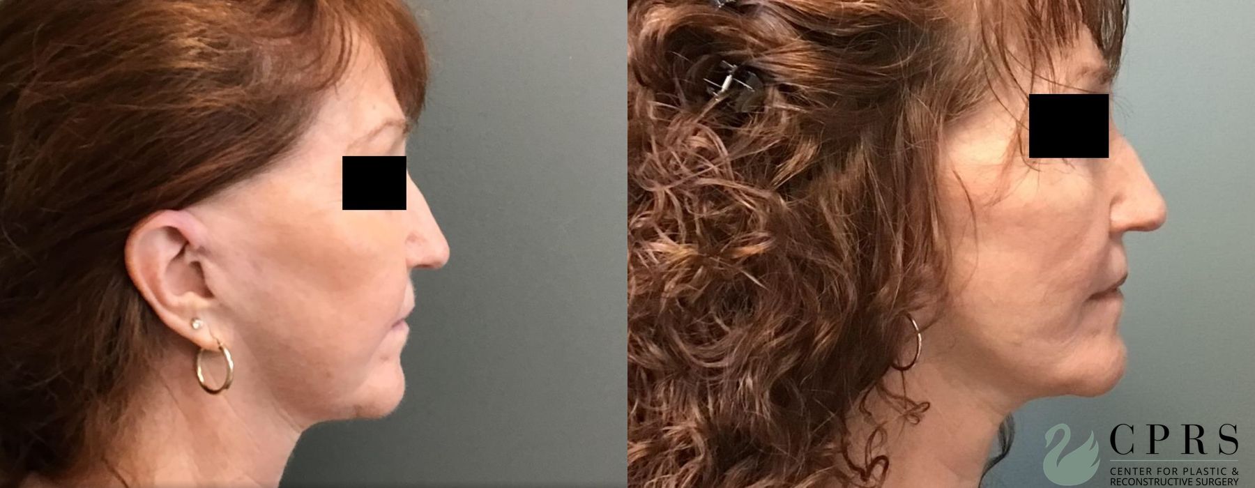 Before photo - Angle 3