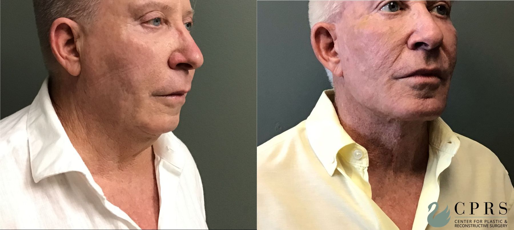 Before and after Chin Augmentation case 49393 - Angle 2