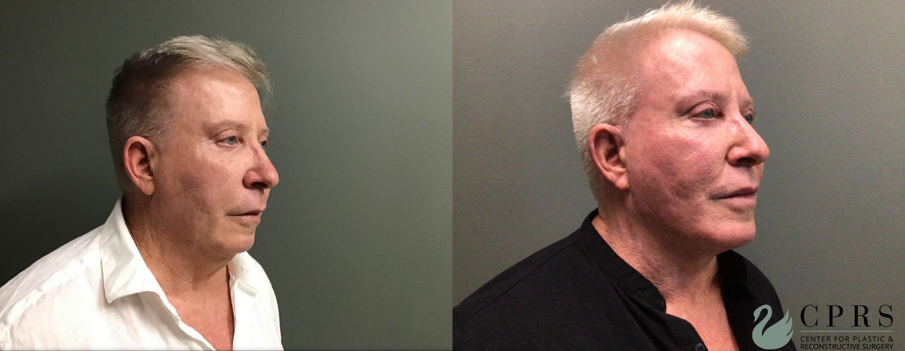 Before and after Facelift & Neck Lift case 19069 - Angle 3