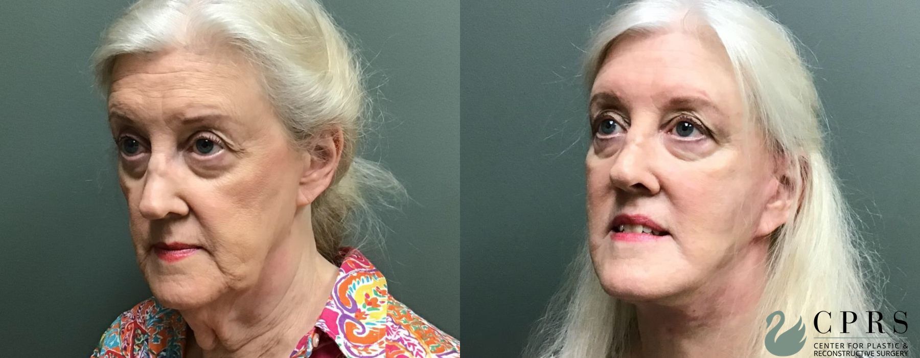 Before photo - Angle 3