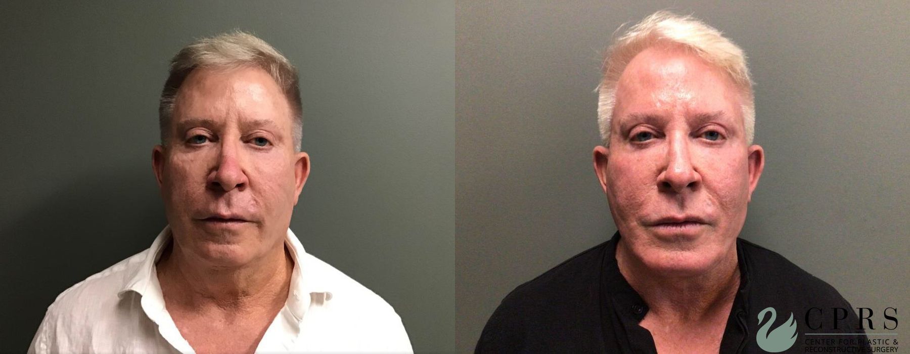 Before and after Facelift & Neck Lift case 19069
