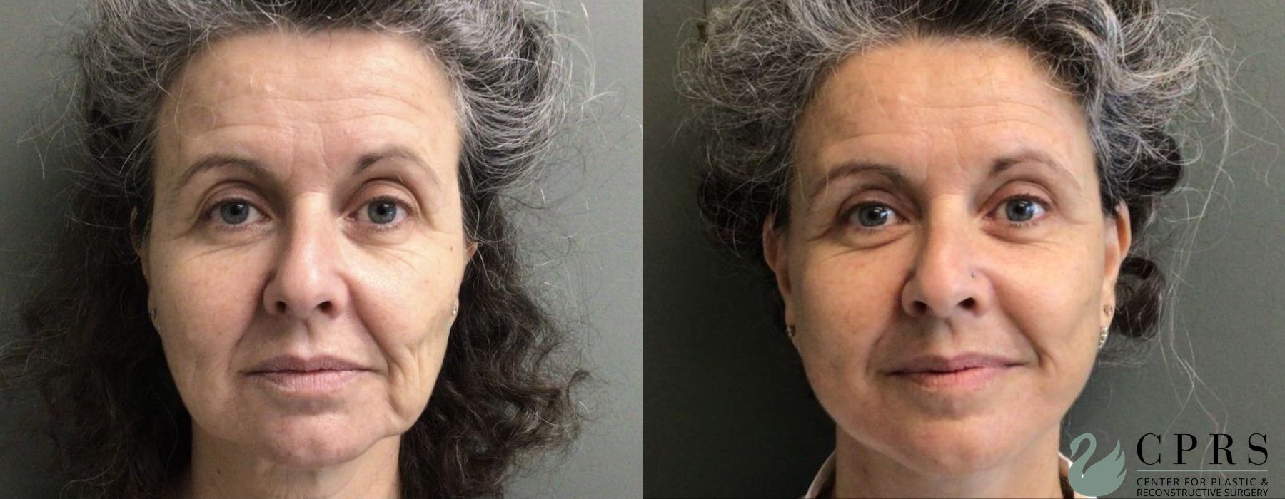 Before and after Facelift & Neck Lift case 19097