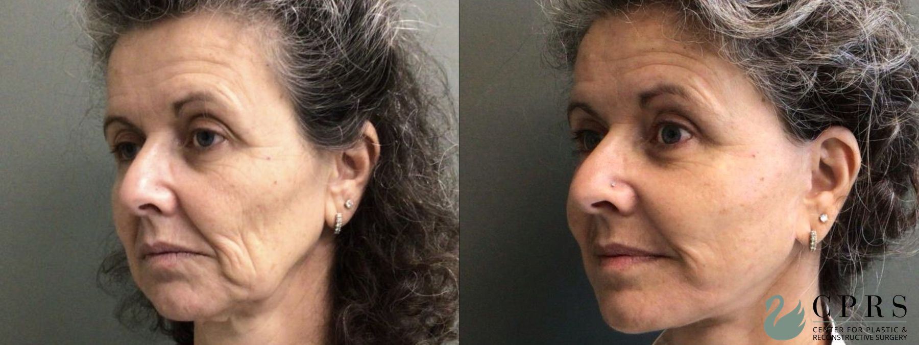 Before and after Facelift & Neck Lift case 19097 - Angle 2