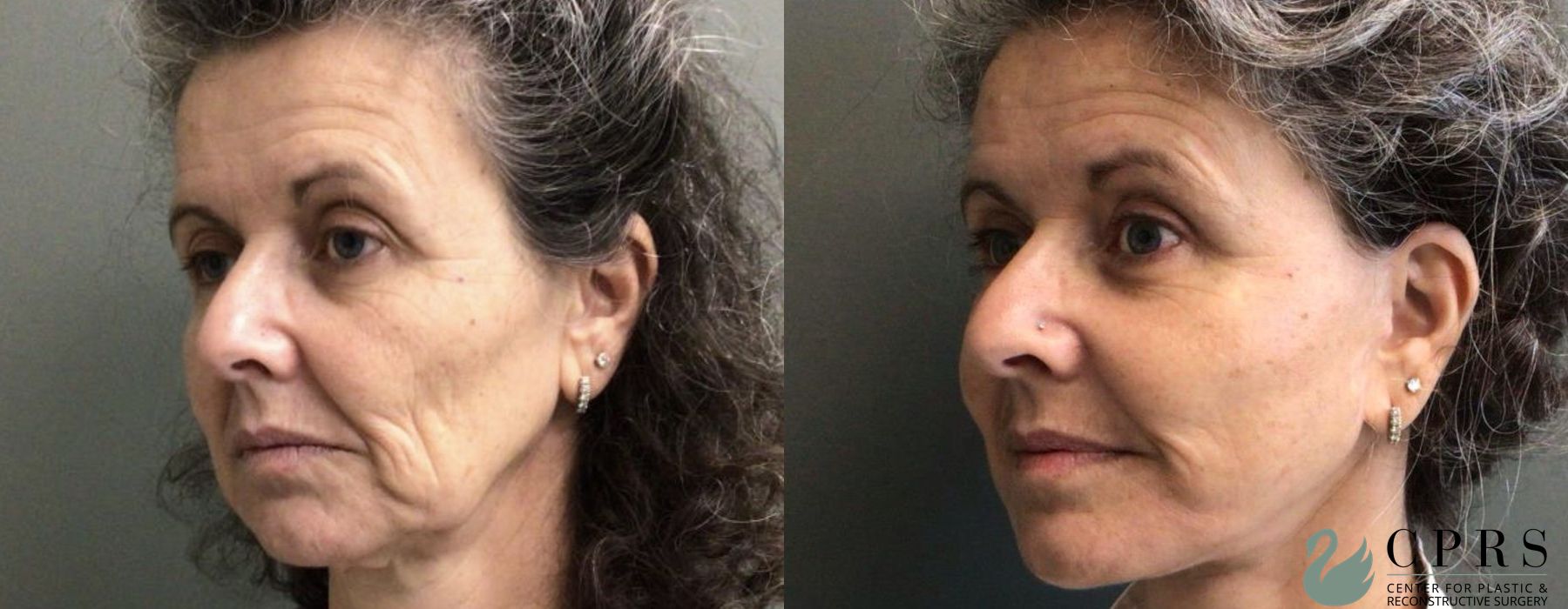 Before and after Facelift & Neck Lift case 19097 - Angle 2